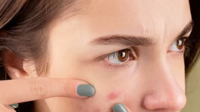 7 Cara Memudarkan Sampai Menghilangkan Noda Bekas Jerawat