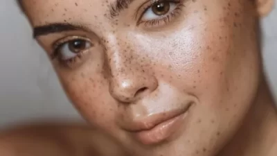 Cara Mencegah Sampai Mengobati Flek Hitam